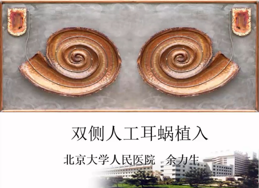 双侧人工耳蜗植入