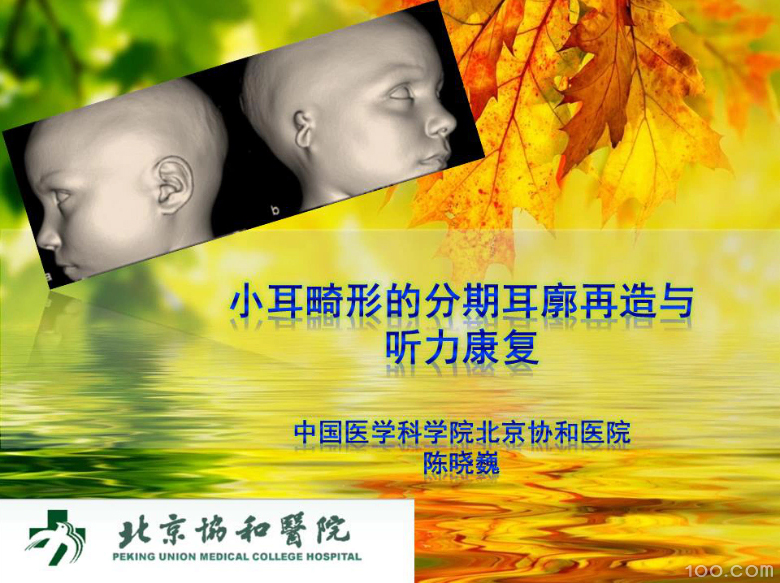 《小耳病人的分期耳廓再造与骨锚式助听器》